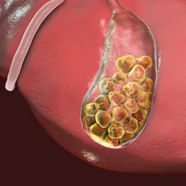 Камни в желчном: удалять пузырь или нет