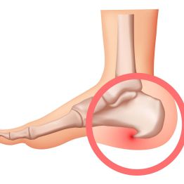 Өкшедегі ауырсынудың себебі неде? Өкше шпоры (табан шпоры) туралы және оны жою әдістері