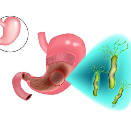 Гастрит, хеликобактер және жақсы гастроэнтеролог іздеу: не нәрсеге көңіл бөлу керек