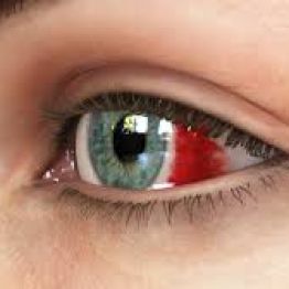 Глаз "налился кровью" − а зрение в порядке. Почему так бывает?