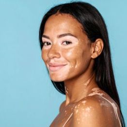 Белые пятна на коже: что такое витилиго и как вернуть уверенность