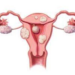 Миома матки − не приговор. Простое объяснение сложного диагноза