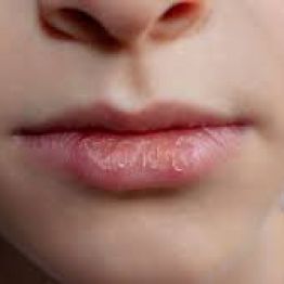 Сухие, потрескавшиеся губы: причины, симптомы и способы лечения