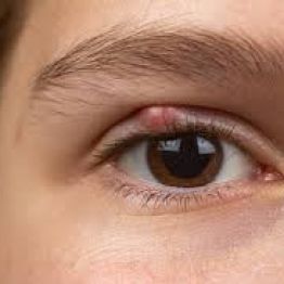 Қабақтағы түйін - халязион ба, әлде көз арпаның ісінуі ме?