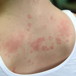 Созылмалы есекжем (крапивница): түсіндіру қиын, бірақ емдеуге болатын ауру