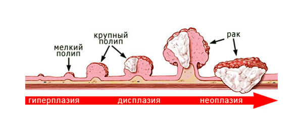 Тоқ ішектің полипінің өсу сатылары