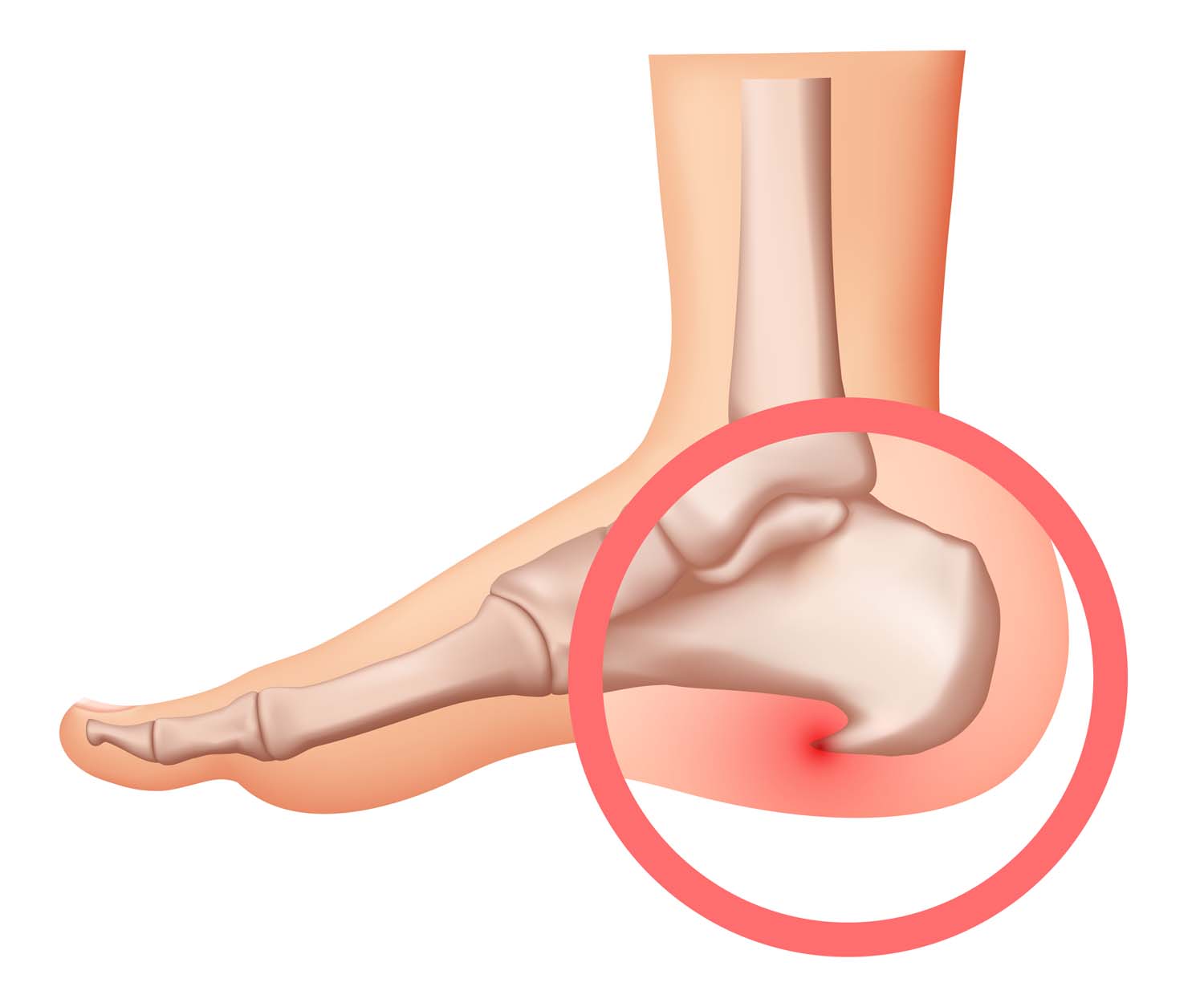 Heel-Spurs-Pain-Treatment.jpg