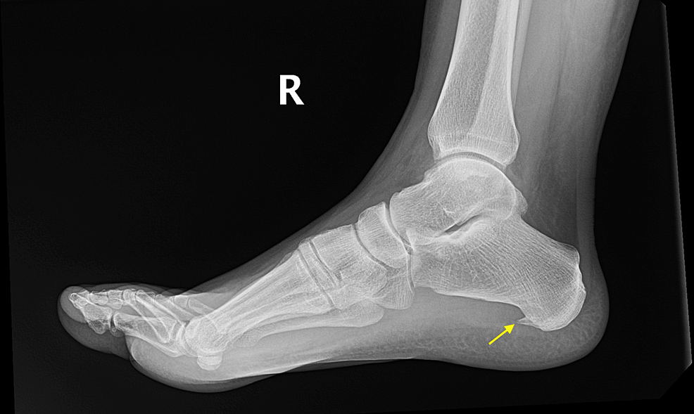 article_river_be801100973c11ee89c937f71f2e233d-Fig.-1-calcaneal-spur.png