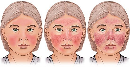 rosacea_3.jpg